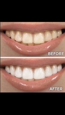 whitening_toothpaste_smile_before_after